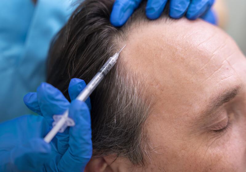 Saç mezoterapisi görseli